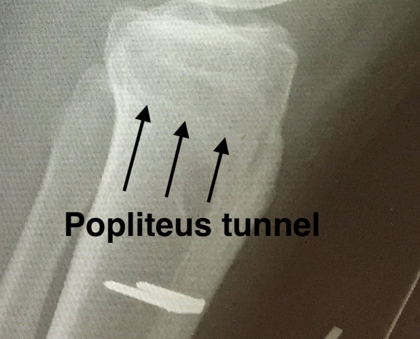 Popliteus tunnel 2